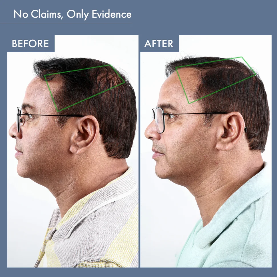 Hair Growth Serum, 50ml + Men's DHT Blocker Supplement, 30N - Image 6