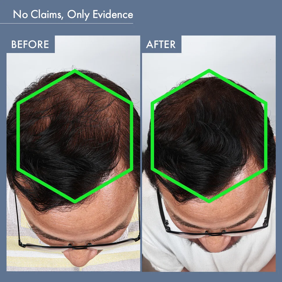 Hair Growth Serum, 50ml + Men's DHT Blocker Supplement, 30N - Image 7