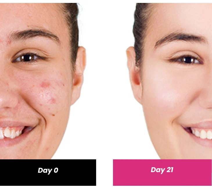 2% Salicylic acid Serum, 30ml - Image 4