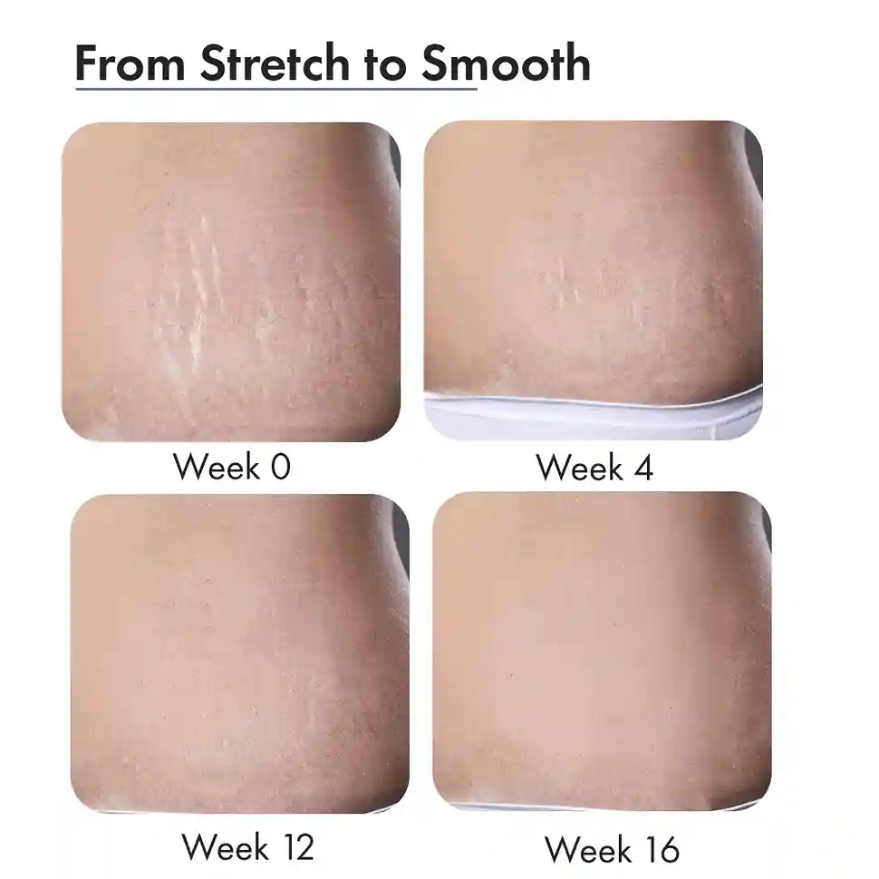 Stretch Marks Expert, Serum Cream, 30ml - Image 12