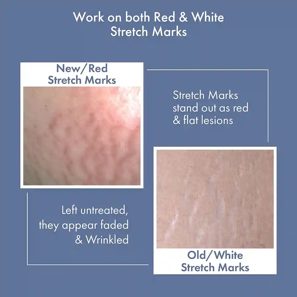 Stretch Marks Expert, Serum Cream, 30ml - Image 5
