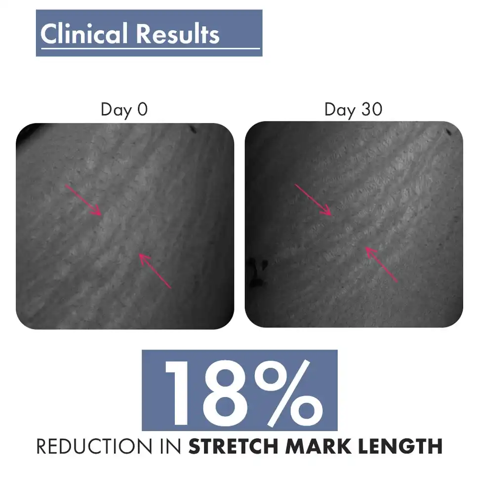 Stretch Marks Expert, Serum Cream, 30ml - Image 7
