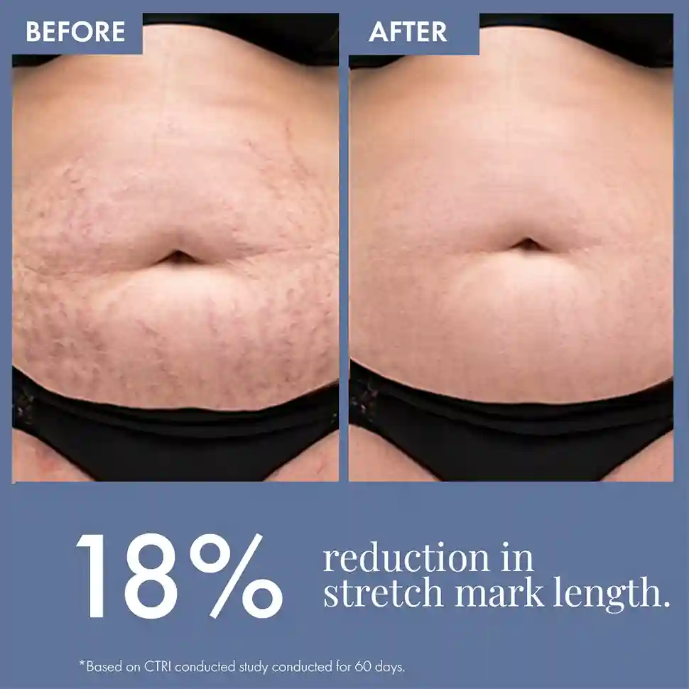 Stretch Marks Expert, Serum Cream, 30ml - Image 8