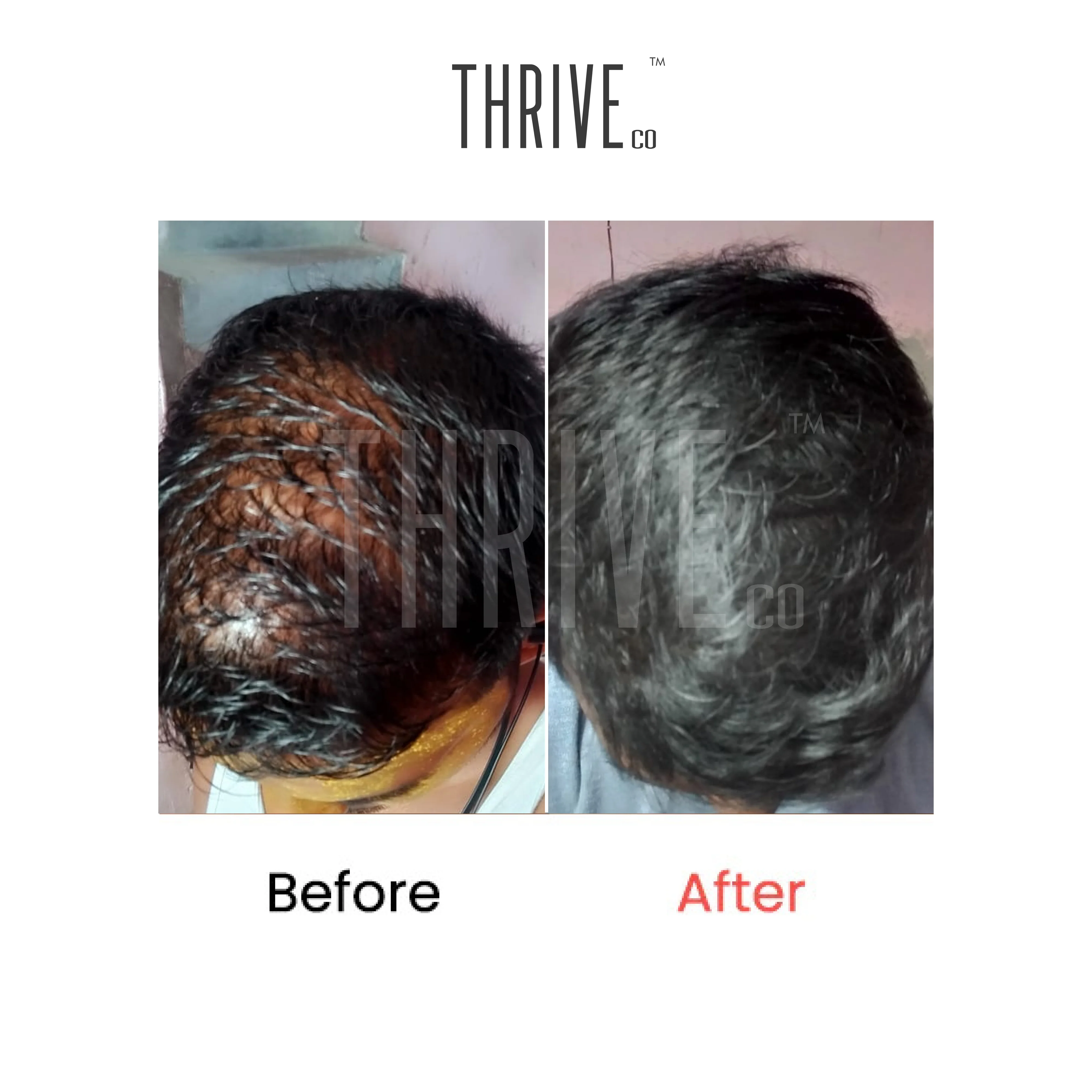 Hair Care Kit: ThriveCo Scalp Scrub (100ml) + Vitalizing Serum (50ml) + Hair Growth Serum (50ml) - Image 5